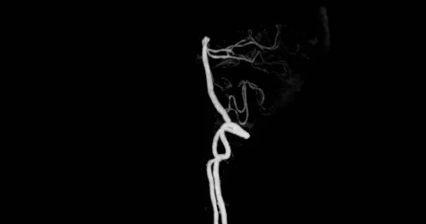 Cta Brain Angiography Brain Showing Basilar Artery — Stock Photo, Image