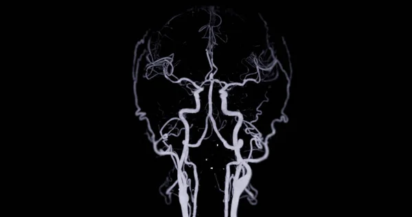 脑Mip技术的Cta脑电图或Ct血管造影图像Ap及侧视显示脑动脉 — 图库照片
