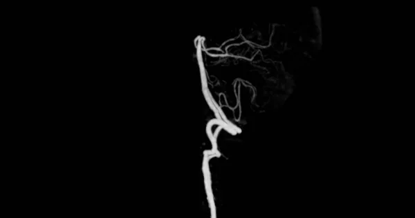 Beyin Tomografisi Anjiyografisi Baziler Arteri Gösteriyor — Stok fotoğraf
