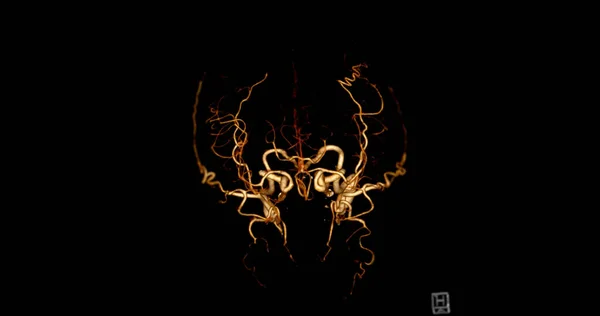 Cta Brain Lub Angiografia Mózgu Rendering Obrazu Boczny Widok Pokazujący — Zdjęcie stockowe