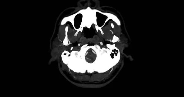 Cta Brain Angiografie Van Hersenen Axiale Mip Zicht Toont Cerebrale — Stockfoto