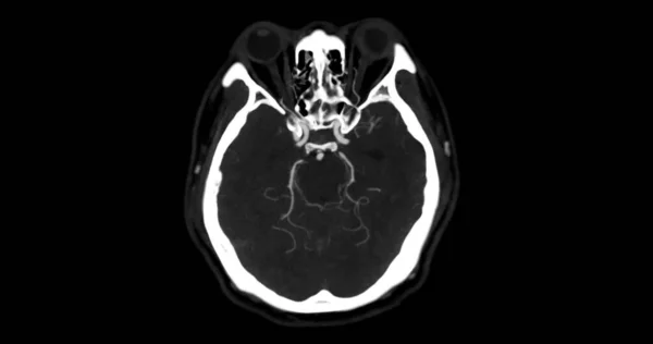 Cta Cerebro Angiografía Por Del Mip Axial Cerebral Que Muestra — Foto de Stock