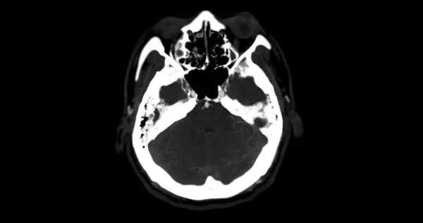 Cta Brainまたは脳動脈を示す脳軸視のCtアングロジー — ストック写真