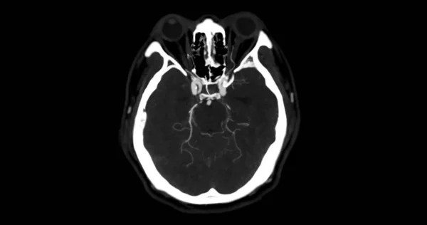 Cta Brain Lub Angiografia Obrazu Mikroskopowego Mózgu Wykazującego Tętnicę Mózgową — Zdjęcie stockowe