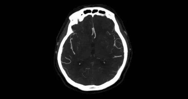 Cta Brain Nebo Angiografie Mozku Axiální Mip Pohled Ukazuje Mozkové — Stock fotografie