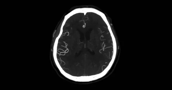 Cta Brain Eller Angiografi Hjärnan Axial Mip Visar Cerebral Artär — Stockfoto