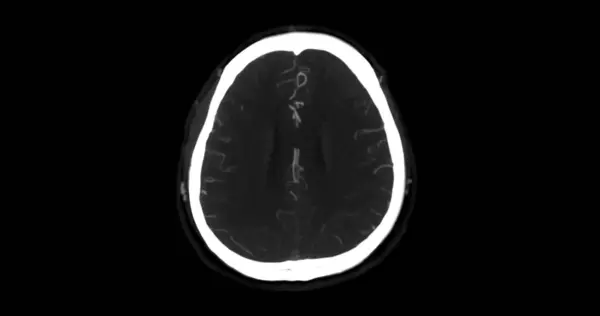 显示脑动脉的Cta脑电图或Ct脑血管造影检查 — 图库照片