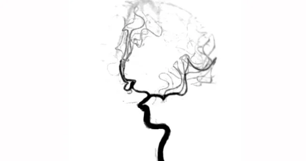 Beyin Anjiyogramının Beyin Anjiyografisi Serebral Arteri Gösteriyor — Stok fotoğraf