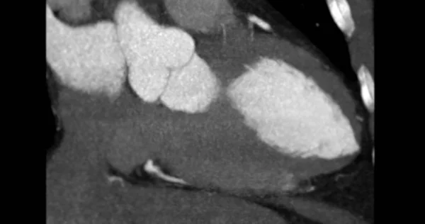 Cardiac Cta Вертикальний Вид Довгу Вісь Профілактики Коронарних Артерій — стокове фото