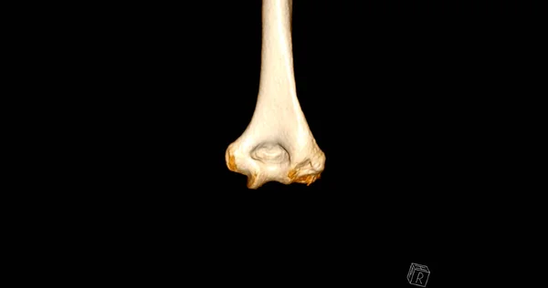 Scan Elbow Joint Rendering Showing Humerus Bone — Fotografia de Stock