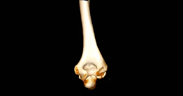 Scan Elbow Joint Rendering Showing Humerus Bone — Stock Photo, Image