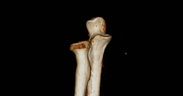 肘关节三维Ct扫描显示尺骨和半径骨 — 图库照片