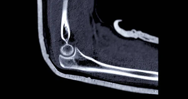 Сканування Сагітального Вигляду Ліктьового Суглоба — стокове фото
