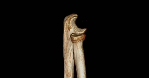 Αξονική Τομογραφία Άρθρωσης Αγκώνα Απόδοση Που Δείχνει Ωλένη Και Κερκίδα — Φωτογραφία Αρχείου