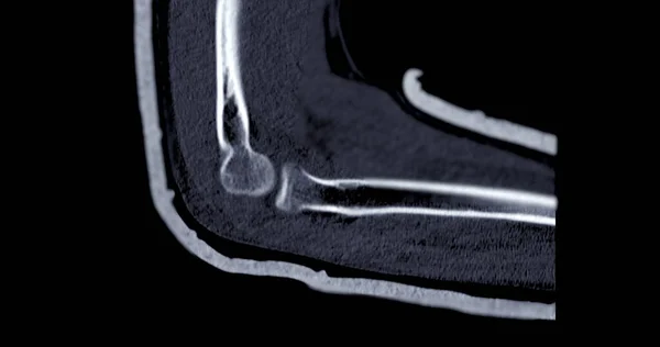 Сканування Сагітального Вигляду Ліктьового Суглоба — стокове фото