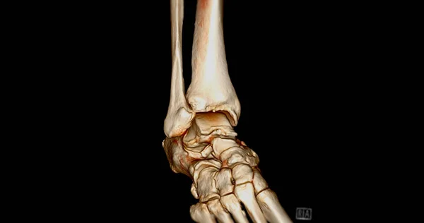 Ct扫描踝关节或脚踝关节三维成像计算机断层扫描 — 图库照片