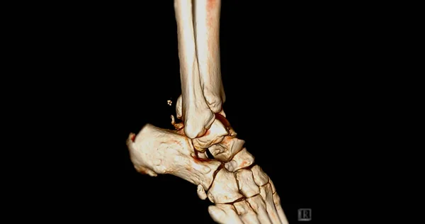 Scan Ankle Joint Computed Tomography Ankle Joint Rendering Image — Stok Foto