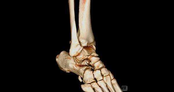 Ct扫描踝关节或脚踝关节三维成像计算机断层扫描 — 图库照片