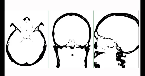 Αξονική Τομογραφία Του Εγκεφάλου Αξονική Στεφανιαία Και Οβελιαία Άποψη Μαύρο — Φωτογραφία Αρχείου