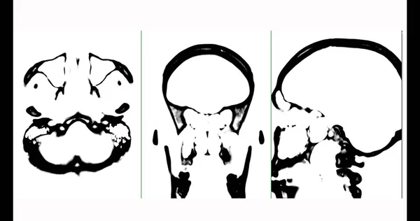 Tomografia Komputerowa Mózgu Trybie Czarno Białym Trybie Osiowym Wieńcowym Strzałkowym — Zdjęcie stockowe