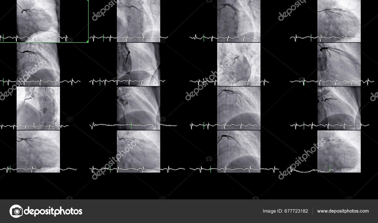 Cardiac Catheterization Can Help Doctor Diagnose Treat Problems Your