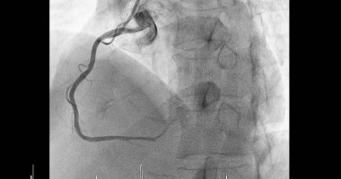 Sağ koroner arterde (RCA) kardiyak kateterizasyon, kalp krizi veya felç gibi kalp ve kan damarlarınızdaki sorunları teşhis ve tedavi etmede yardımcı olabilir..