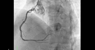 Sağ koroner arterde (RCA) kardiyak kateterizasyon, kalp krizi veya felç gibi kalp ve kan damarlarınızdaki sorunları teşhis ve tedavi etmede yardımcı olabilir..
