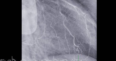 Sol anterior inen arterdeki (LAD) kardiyak kateterizasyon, kalp krizi veya felç gibi kalp ve kan damarlarındaki sorunların teşhis ve tedavisine yardımcı olabilir..