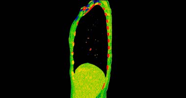 Pulmoner embolizma (PE), akciğer kanseri ve covid-19 için renk modunda göğüs sagital görüntüsünün CT taraması. 