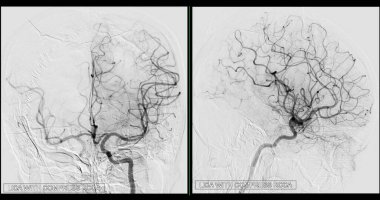 Cerebral angiography  image from Fluoroscopy in intervention radiology  showing cerebral artery.