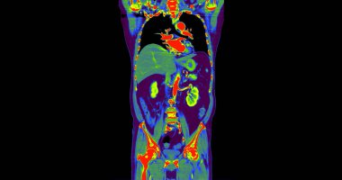 CT Göğüs ve karın enjeksiyonlu kontrastlı göğüs ve karın ağrısı teşhisi için medya koronal görüntüsü.