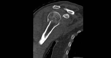 Omuz ekleminin tomografisi, omuz ekleminin kırılması durumunda....