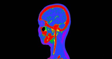 Beynin CT anjiyografisi veya CTA beyin ve boyun görüntüsü 3D görüntü birleştirme renk modu. tıbbi teknoloji kavramı.
