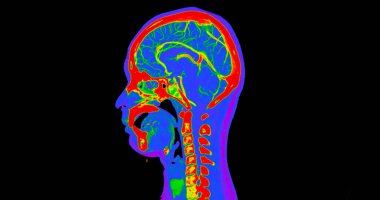 Beynin CT anjiyografisi veya CTA beyin ve boyun görüntüsü 3D görüntü birleştirme renk modu. tıbbi teknoloji kavramı.