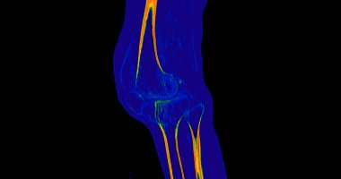 Diz eklemli sagital görünüm tomografisi veya CT taraması .