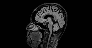 Beyin hastalıklarını tespit etmek için MRI beyin taraması sagittal yetenek. Beyin hastalıklarını felç, beyin tümörleri ve enfeksiyonları olarak tanımlamak için..