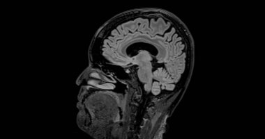 Beyin hastalıklarını tespit etmek için MRI beyin taraması sagittal yetenek. Beyin hastalıklarını felç, beyin tümörleri ve enfeksiyonları olarak tanımlamak için..