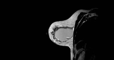 Göğüs MR 'ı ya da göğüs röntgeninin her iki tarafında göğüs silikonu olan göğüs kanseri taraması..