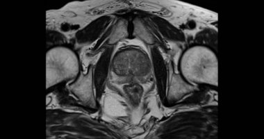 Yaşlı erkeklerde prostat kanseri hücresi teşhisi için MRI prostat bezi eksenli T2W.