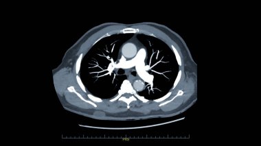 Kronik Pulmoner embolizma (PE), akciğer kanseri ve covid-19 için CTPA veya CTA pulmoner arter. .