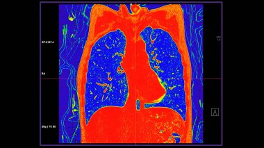 Pulmoner embolizma (PE), akciğer kanseri ve covid-19 için renk modunda göğüs koronal görüntüsünün CT taraması. 