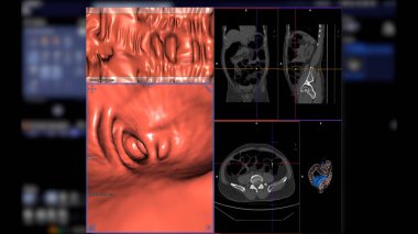CT kolonografisi 2D Axial, sagittal, koronal düzlem ve kolorektal kanseri taramak için 3D görüntüyü karşılaştırır. Kolon kanseri için yıllık sağlık kontrolleri.