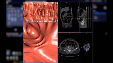 CT kolonografisi 2D Axial, sagittal, koronal düzlem ve kolorektal kanseri taramak için 3D görüntüyü karşılaştırır. Kolon kanseri için yıllık sağlık kontrolleri.