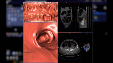 CT kolonografisi 2D Axial, sagittal, koronal düzlem ve kolorektal kanseri taramak için 3D görüntüyü karşılaştırır. Kolon kanseri için yıllık sağlık kontrolleri.
