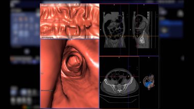 CT kolonografisi 2D Axial, sagittal, koronal düzlem ve kolorektal kanseri taramak için 3D görüntüyü karşılaştırır. Kolon kanseri için yıllık sağlık kontrolleri.