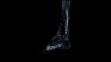 MRI FOOT taraması Sagittal görünüm T2 Yağ bastırma tekniği teşhis tendonu yaralanması için.