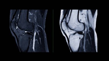 Diz ekleminin manyetik rezonans görüntülemesi veya ön çapraz bağ dokusunda yırtılma veya burkulma tespit etmek için MRI diz sagittali (ACL).