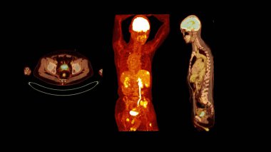 Tüm insan vücudunun tomografi görüntüsü. Tomografi, koronal ve sagital düzlem. Pozitron Emisyonu Hesaplanmış Tomografi .
