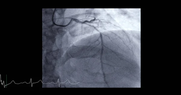 Cateterizzazione Cardiaca Sull Arteria Discendente Anteriore Sinistra Lad Può Aiutare — Foto Stock