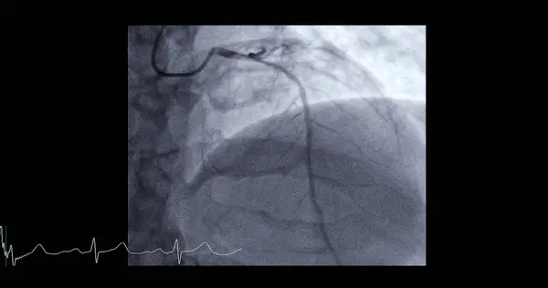 Cardiac catheterization on  left anterior descending artery (LAD) can help doctor diagnose and treat problems in your heart and blood vessels  such as a heart attack or stroke.